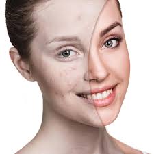 Acne Treatment - Beauty Emporium Acne Treatment SP02002